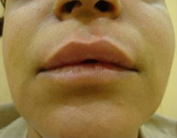 Dermal Fillers Treatment