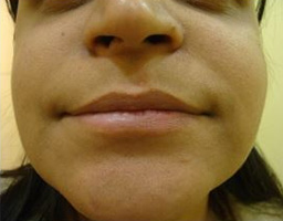 Dermal Fillers Treatment