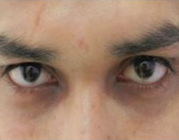 Dermal Fillers Treatment