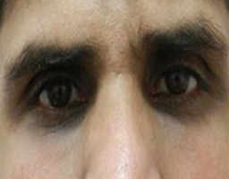 Dermal Fillers Treatment