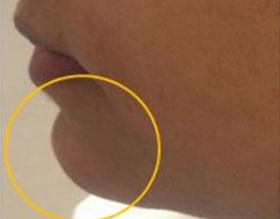 Dermal Fillers Treatment