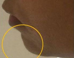 Dermal Fillers Treatment