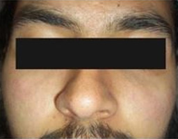 Dermal Fillers Treatment