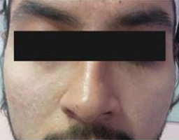 Dermal Fillers Treatment
