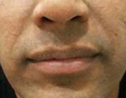 Dermal Fillers Treatment