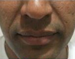 Dermal Fillers Treatment