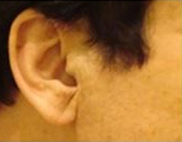 Dermal Fillers Treatment
