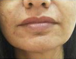 Dermal Fillers Treatment