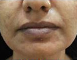 Dermal Fillers Treatment