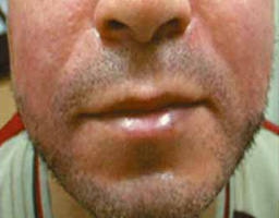 Dermal Fillers Treatment