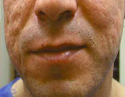 Dermal Fillers Treatment
