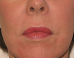 Dermal Fillers Treatment