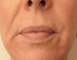 Dermal Fillers Treatment