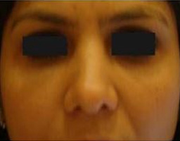 Dermal Fillers Treatment