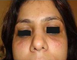 Dermal Fillers Treatment