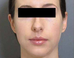 Dermal Fillers Treatment