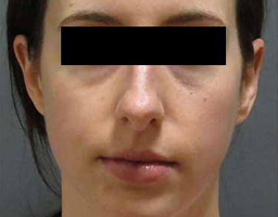 Dermal Fillers Treatment