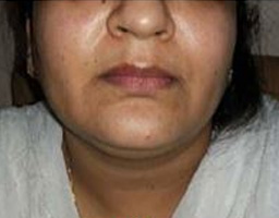 Dermal Fillers Treatment