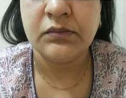 Dermal Fillers Treatment