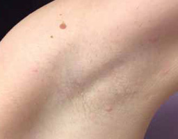 Pain-Free Hair Removal