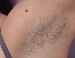 Pain-Free Hair Removal