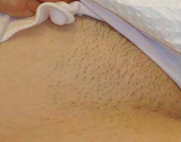 Pain-Free Hair Removal