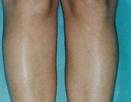 Pain-Free Hair Removal
