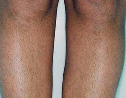 Pain-Free Hair Removal