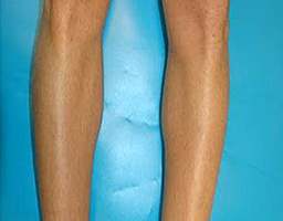 Pain-Free Hair Removal