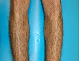 Pain-Free Hair Removal