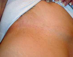 Pain-Free Hair Removal