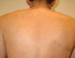 Pain-Free Hair Removal