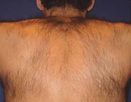 Pain-Free Hair Removal