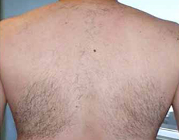 Pain-Free Hair Removal
