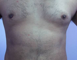 Pain-Free Hair Removal
