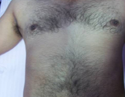 Pain-Free Hair Removal