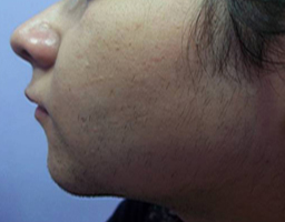 Pain-Free Hair Removal