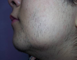 Pain-Free Hair Removal