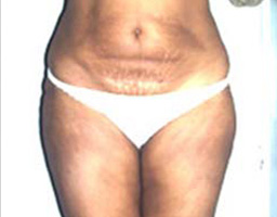 Liposuction