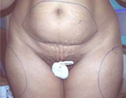 Liposuction