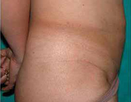 Liposuction