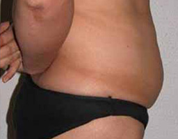 Liposuction