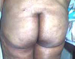 Liposuction