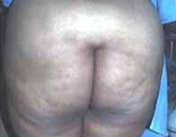 Liposuction