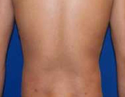 Liposuction