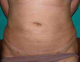 Liposuction