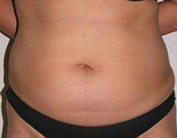 Liposuction