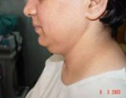Liposuction