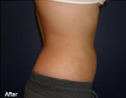 Liposuction