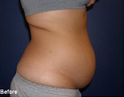 Liposuction